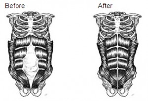 diastasis-recti-before-after